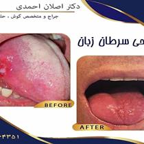 جراحی سرطان زبان