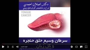 فیلم جراحی سرطان حنجره و زبان