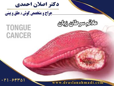 درمان سرطان زبان